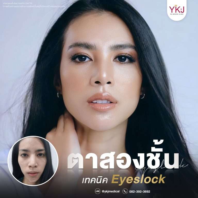 ภาพก่อนหลังทำตาสองชั้น , ภาพก่อนหลังแก้ตาสองชั้น