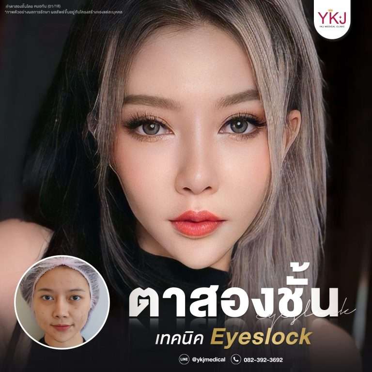 รีวิวตาสองชั้น , รีวิวแก้ตาสองชั้น, ทำตาสองชั้น