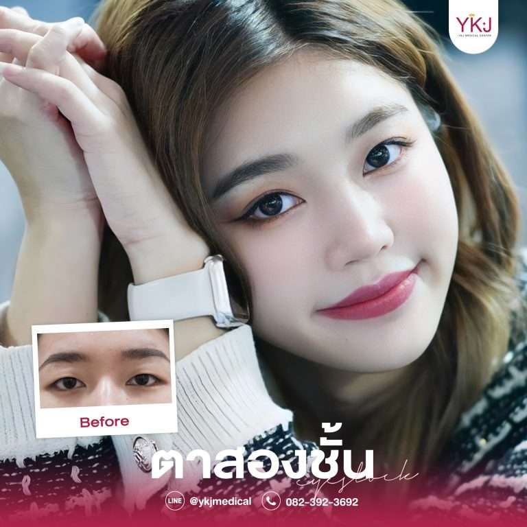 รีวิวตาสองชั้น , รีวิวแก้ตาสองชั้น, ทำตาสองชั้น