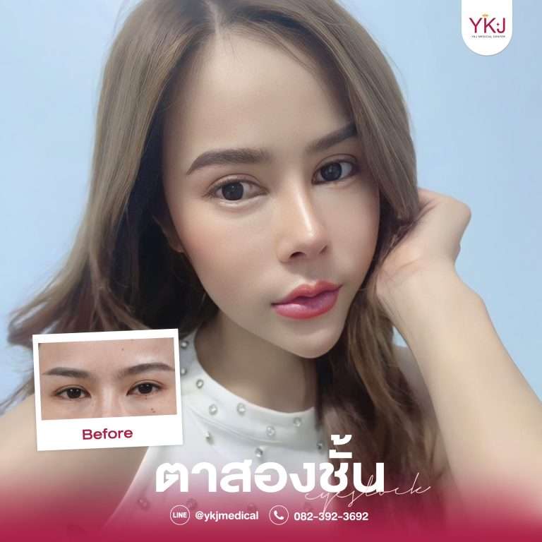 รีวิวตาสองชั้น , รีวิวแก้ตาสองชั้น, ทำตาสองชั้น