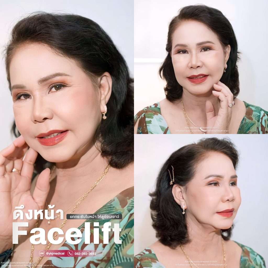 การดึงหน้า-ดึงหน้า-facelift