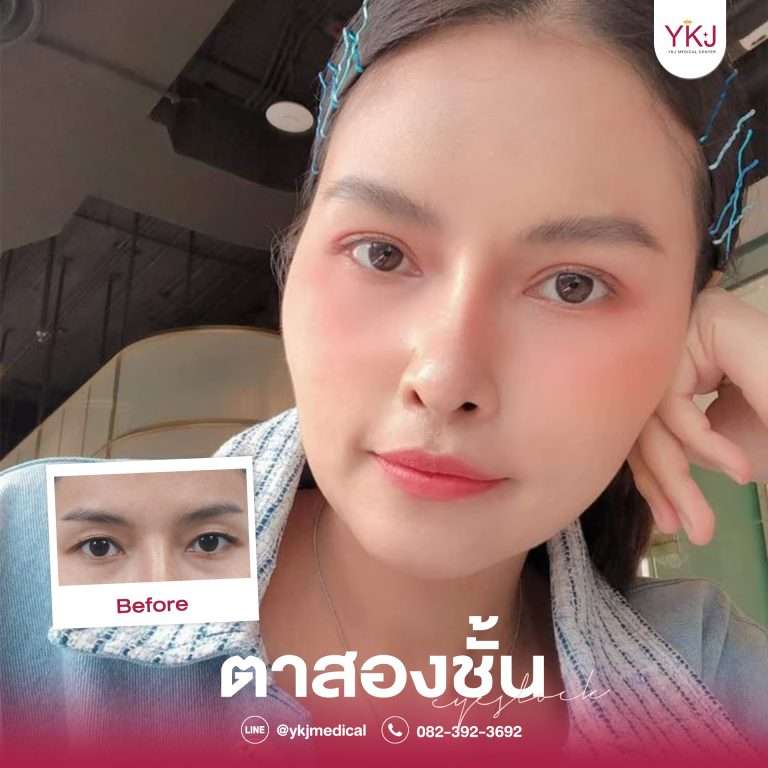 รีวิวตาสองชั้น , รีวิวแก้ตาสองชั้น, ทำตาสองชั้น