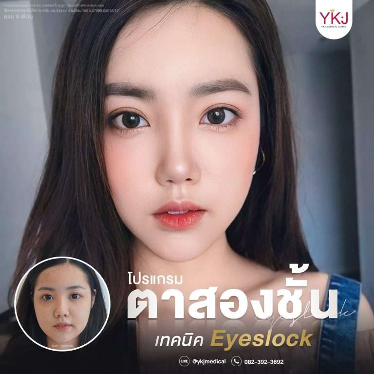 รีวิวตาสองชั้น , รีวิวแก้ตาสองชั้น, ทำตาสองชั้น