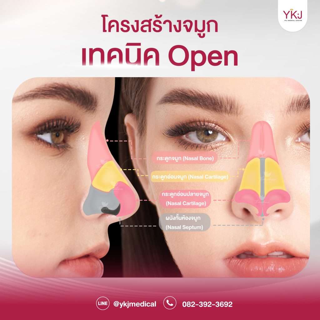 Openกระดูกซี่โครง-Open-ribcartilage