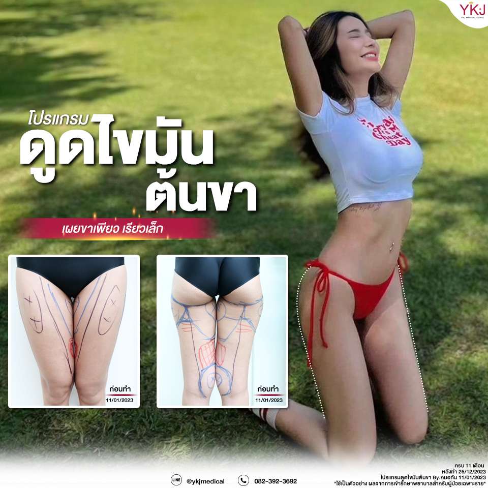 ดูดไขมัน-Liposuction