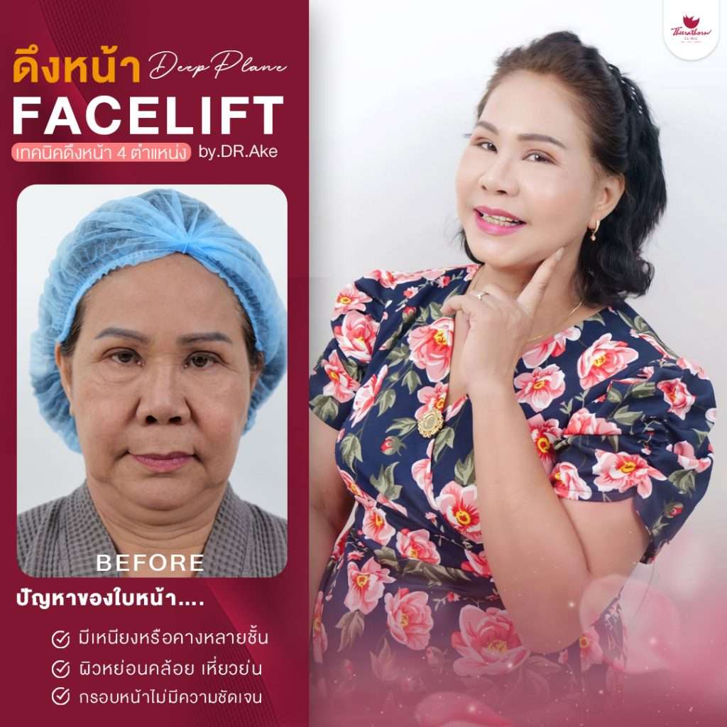 ดึงหน้า-facelift
