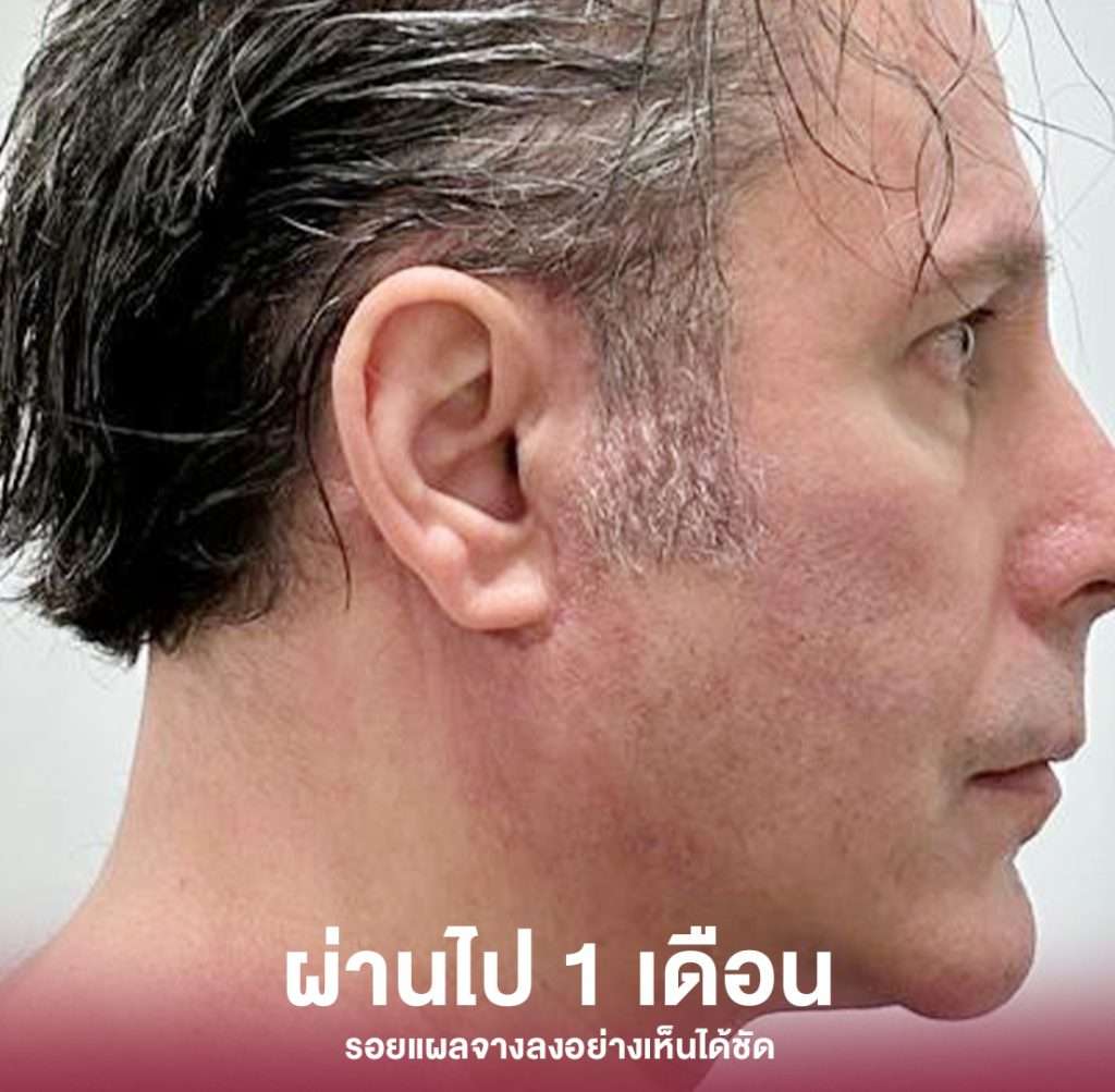 ดึงหน้า-facelift