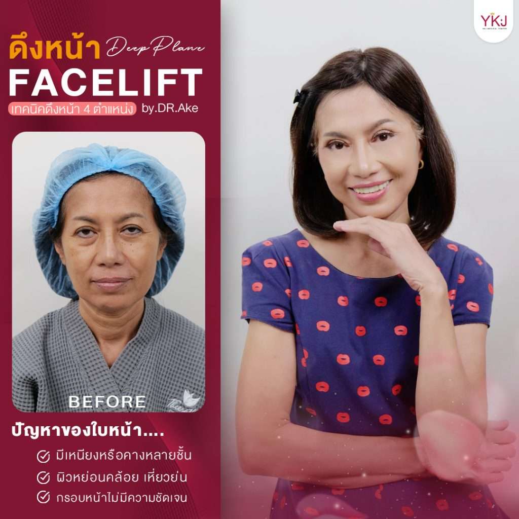 ดึงหน้า-facelift