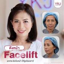 ดึงหน้า-facelift