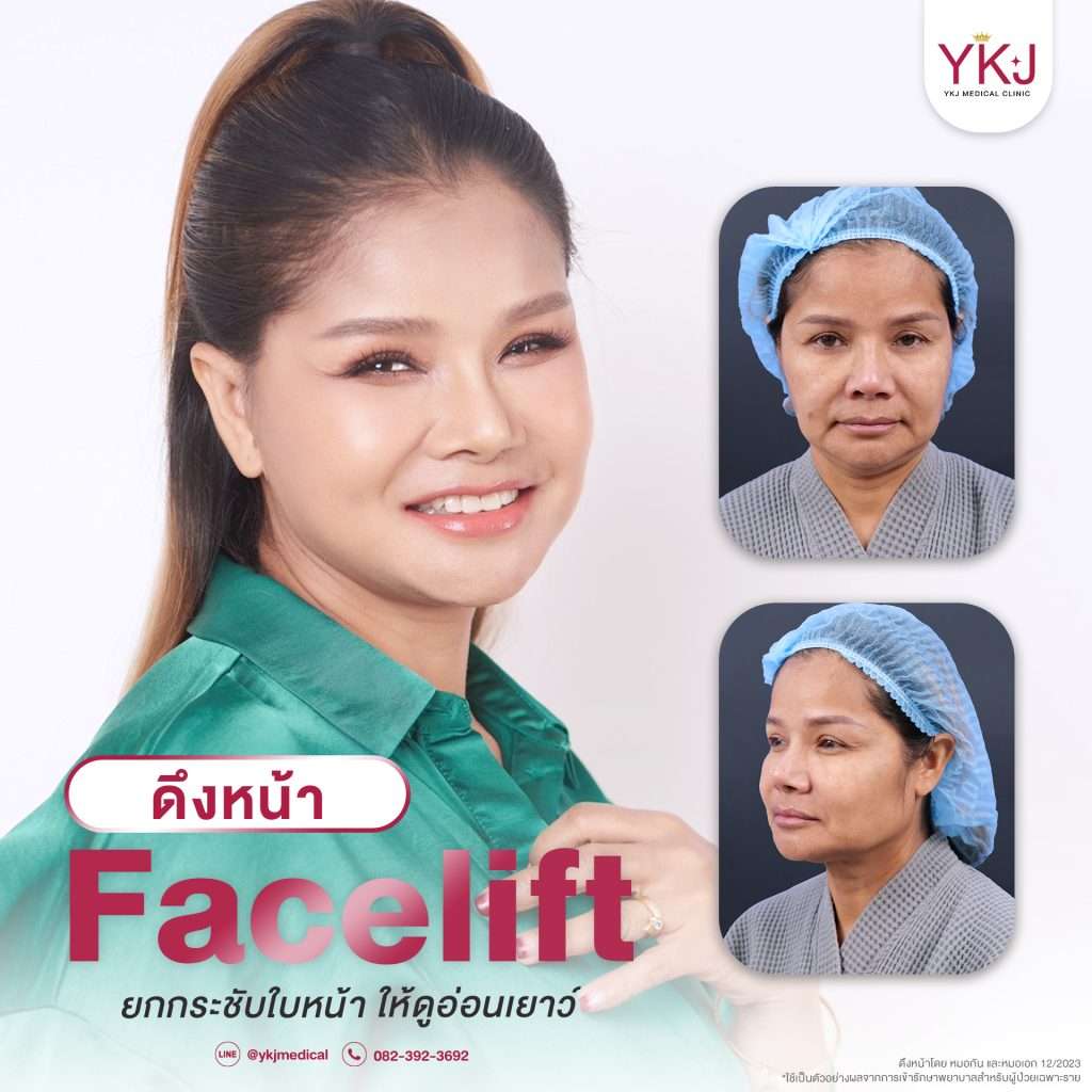 ดึงหน้า-facelift