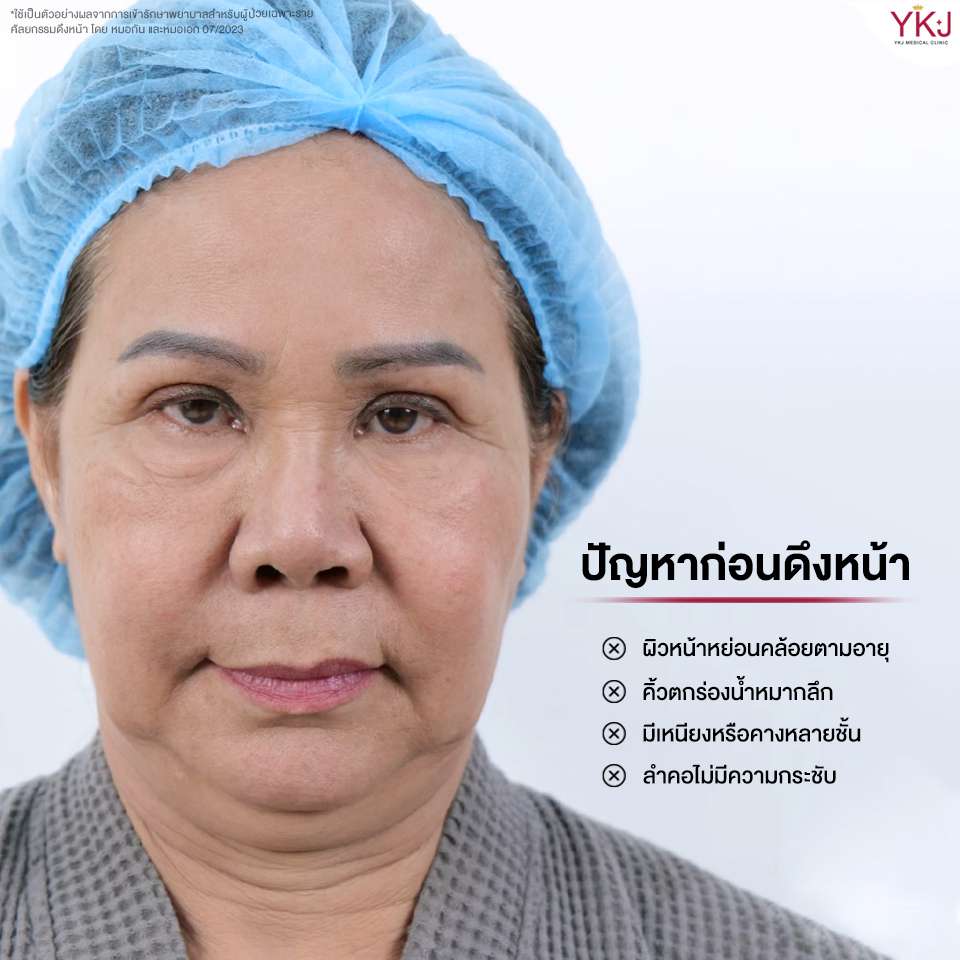 ดึงหน้า-facelift