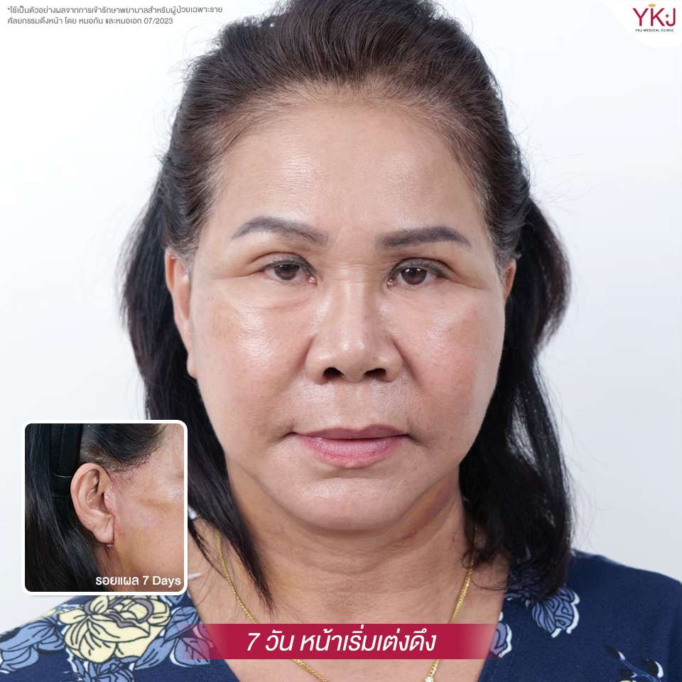 ดึงหน้า-facelift