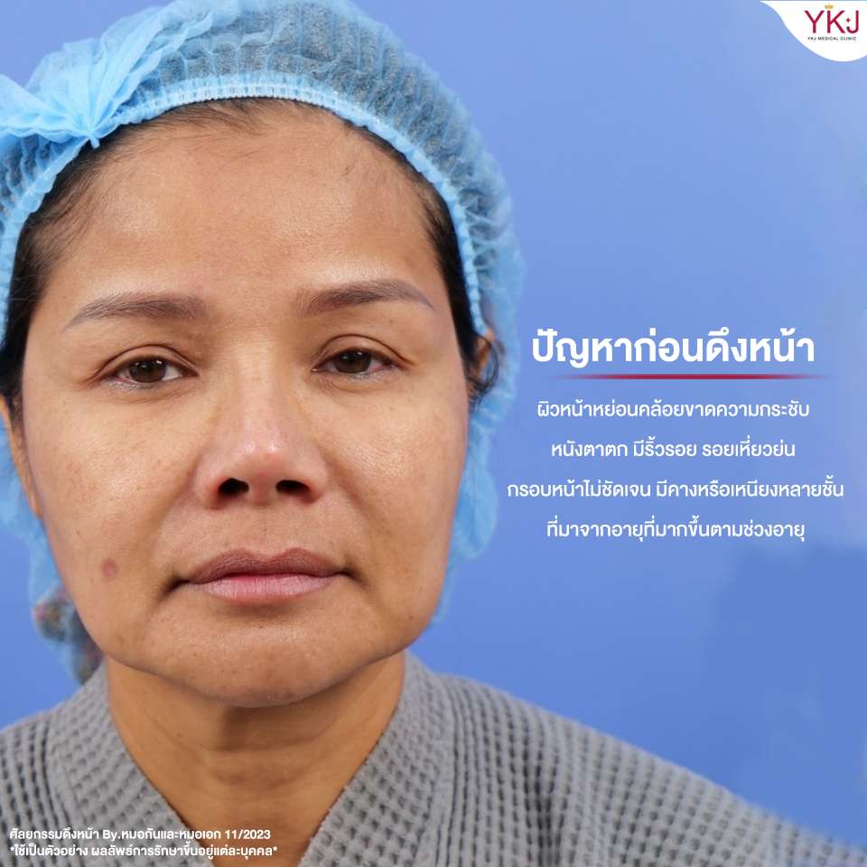 ดึงหน้า-facelift