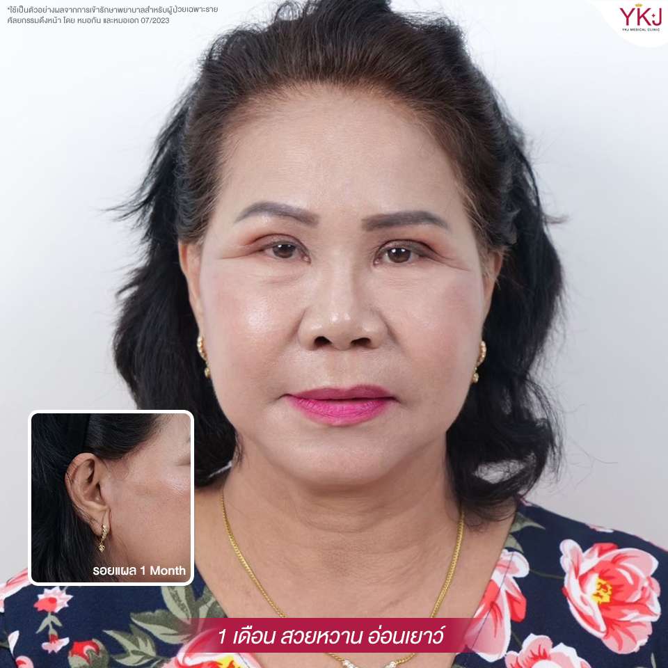 ดึงหน้า-facelift