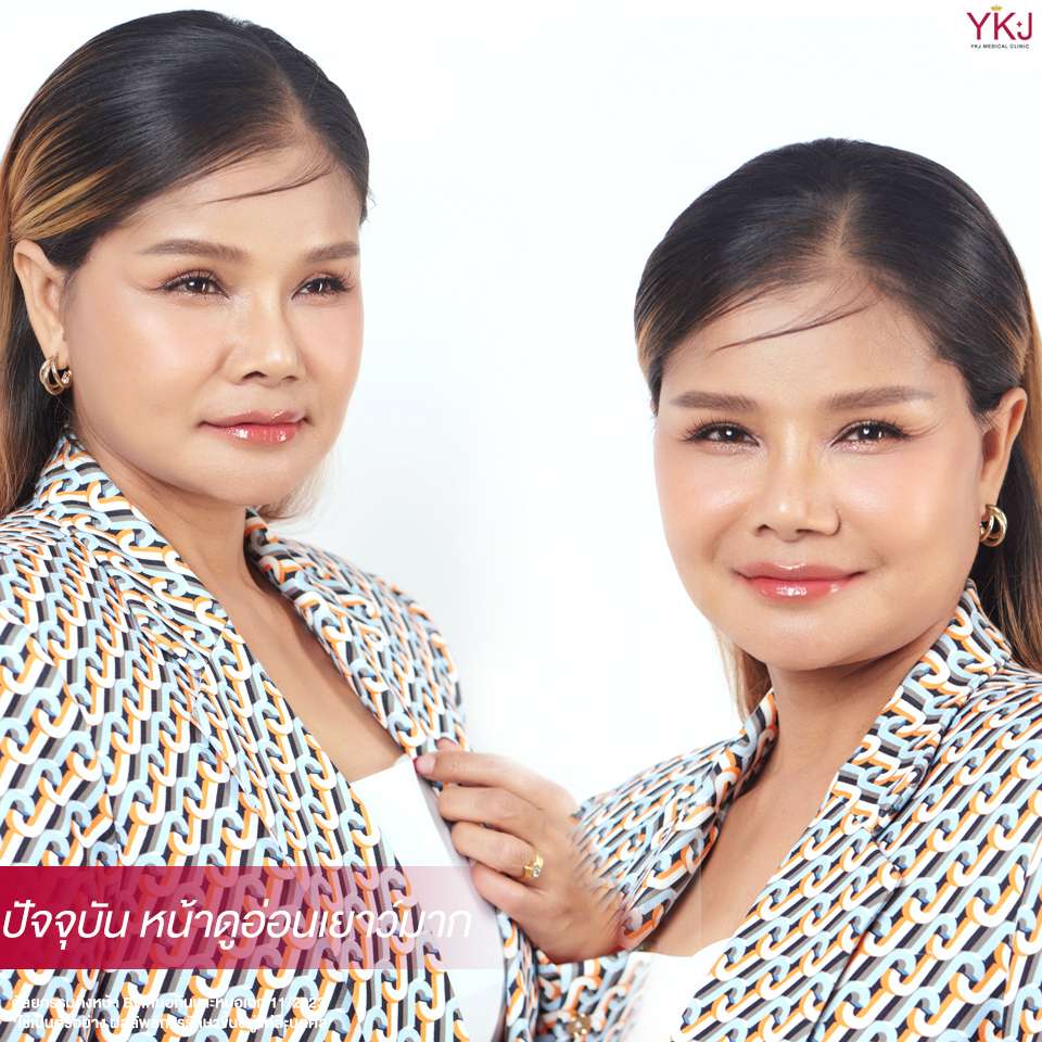 ดึงหน้า-facelift