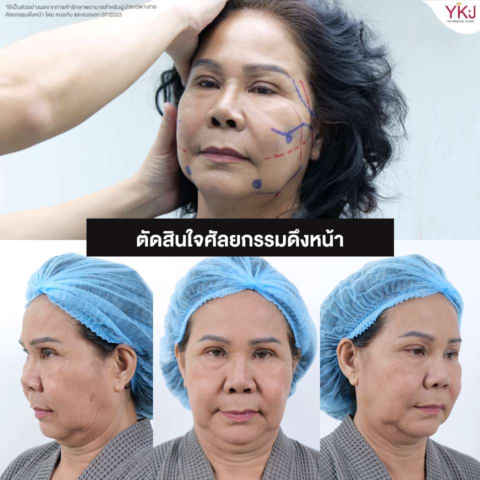 ดึงหน้า-facelift