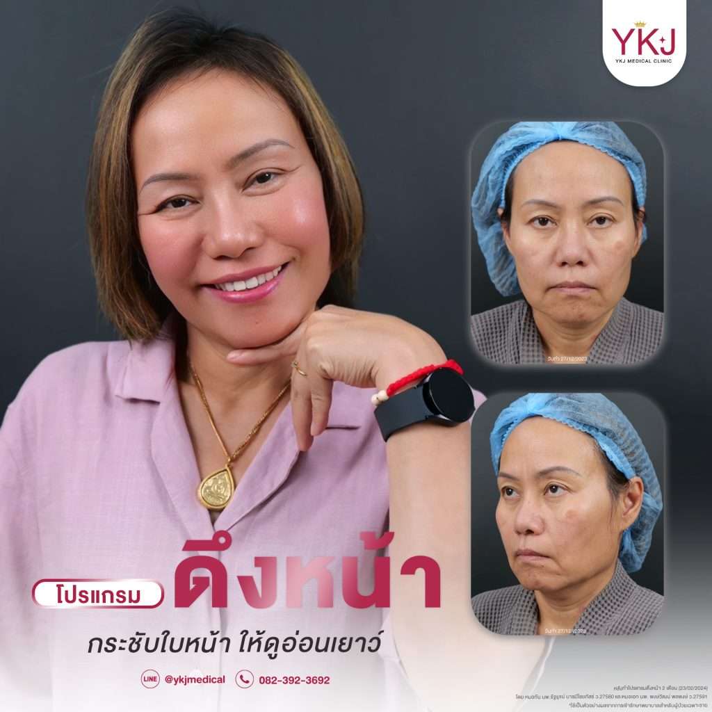 ดึงหน้า-facelift