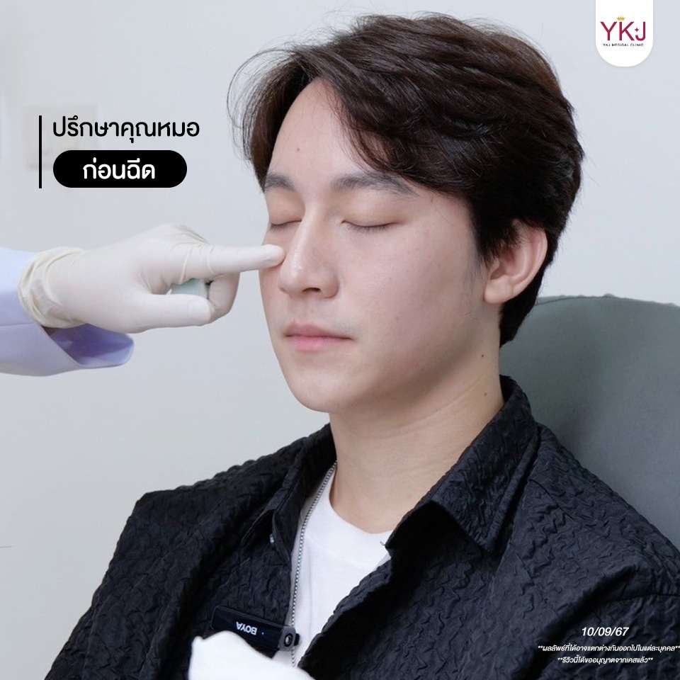 ใต้ตาคล้ำ-ฟิลเลอร์-filler