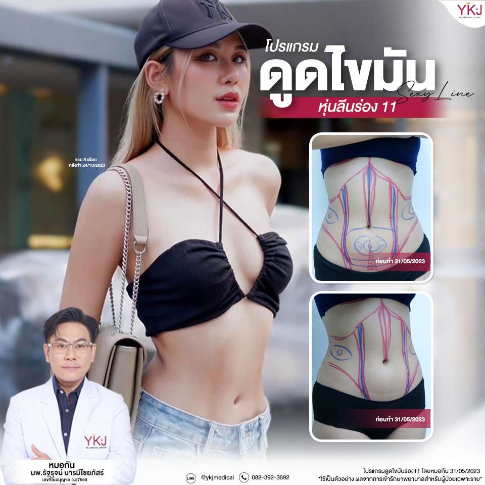 ดูดไขมัน-Liposuction