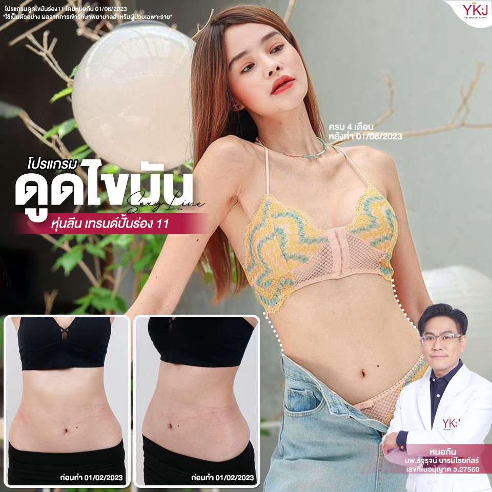 ดูดไขมัน-Liposuction