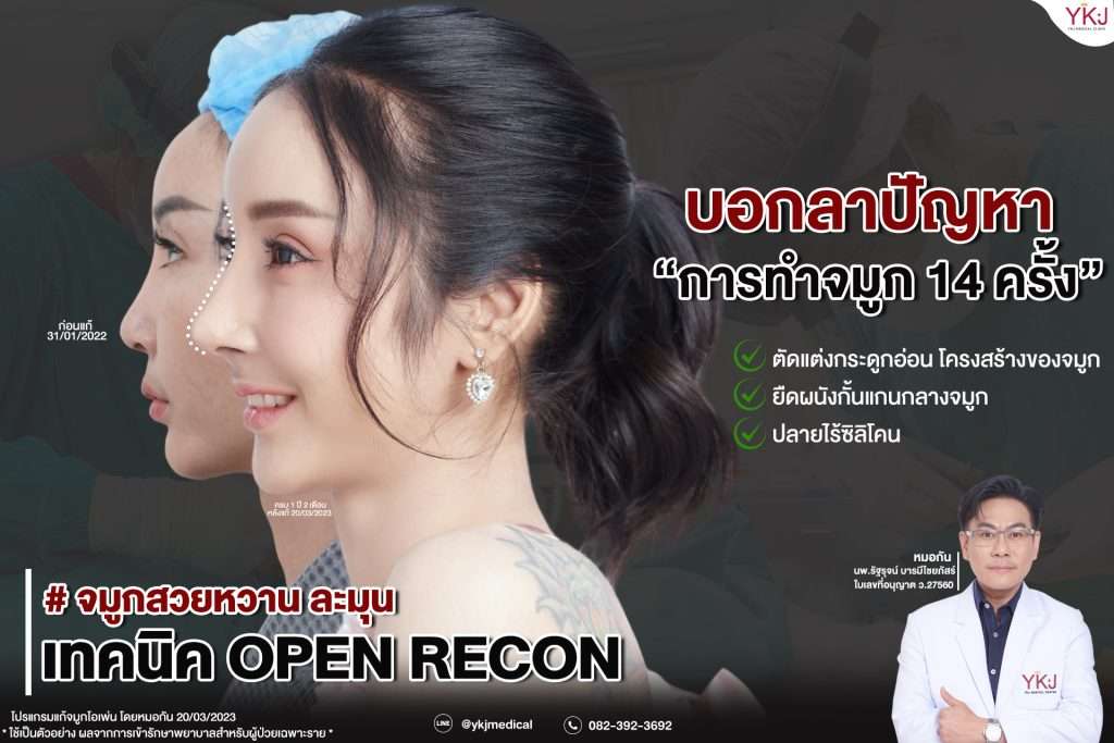 Openกระดูกซี่โครง-Open-ribcartilage