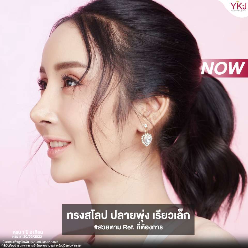 Openกระดูกซี่โครง-Open-ribcartilage