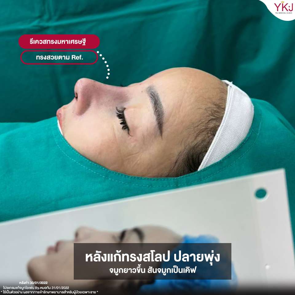 Openกระดูกซี่โครง-Open-ribcartilage