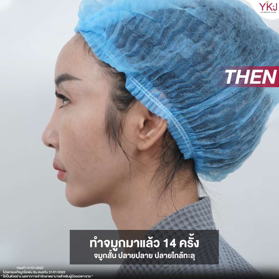 Openกระดูกซี่โครง-Open-ribcartilage