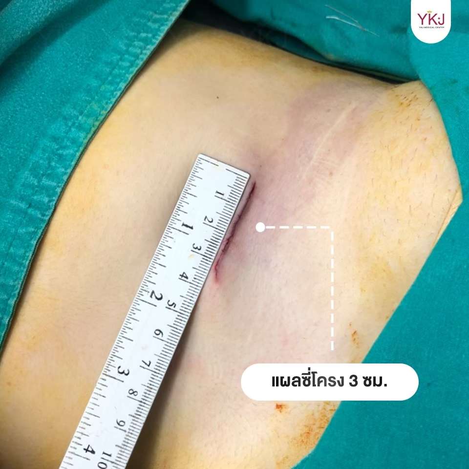 Openกระดูกซี่โครง-Open-ribcartilage