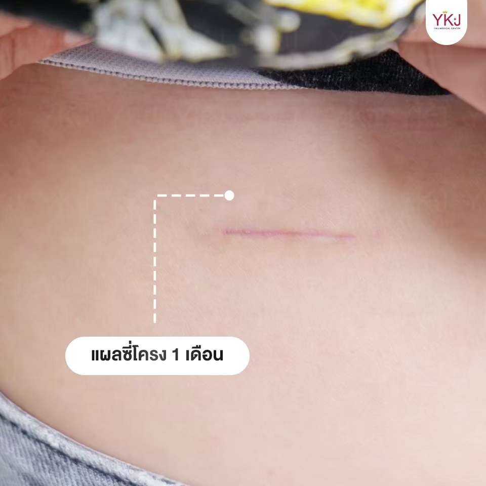Openกระดูกซี่โครง-Open-ribcartilage