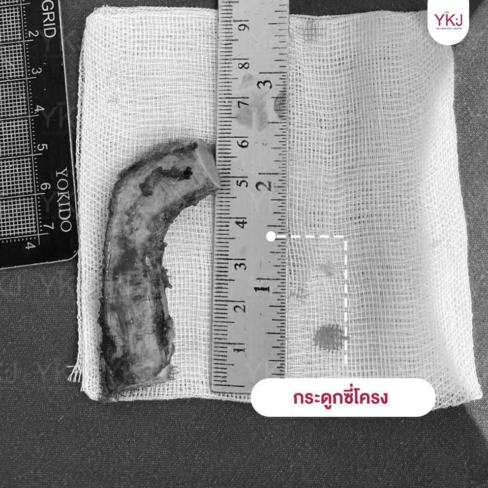 Openกระดูกซี่โครง-Open-ribcartilage