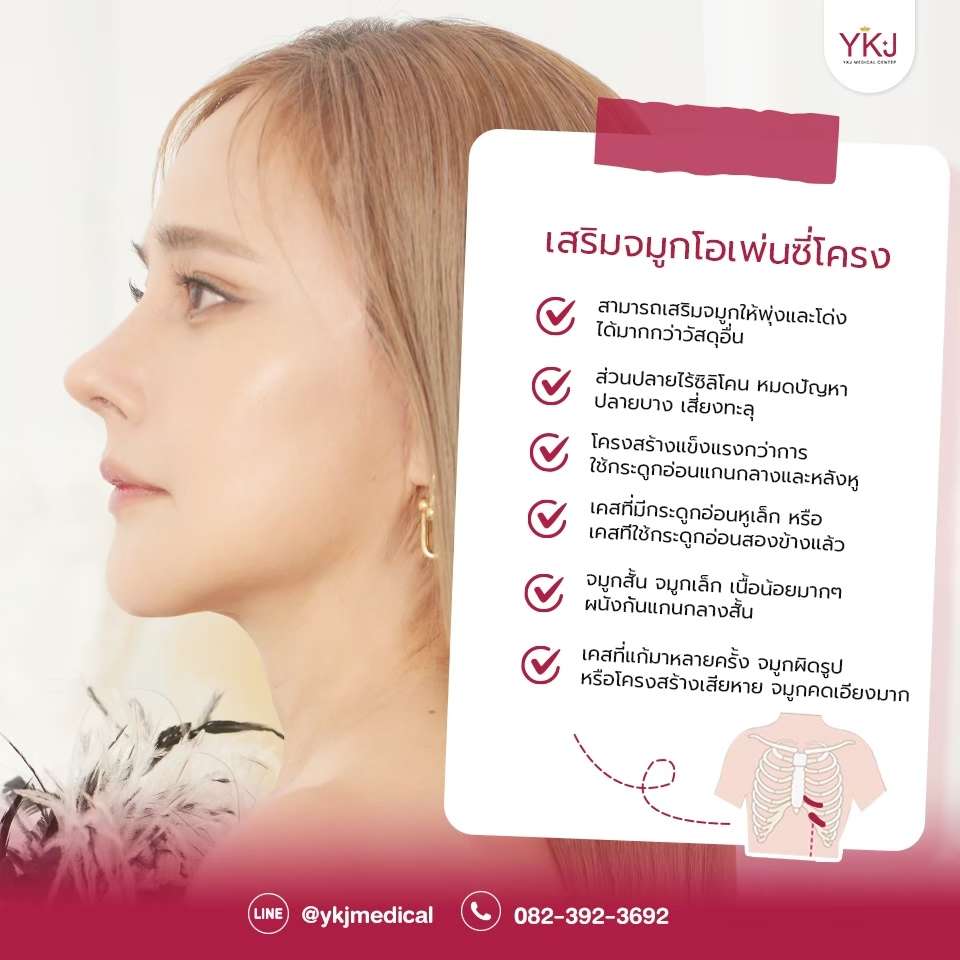 Openกระดูกซี่โครง-Open-ribcartilage