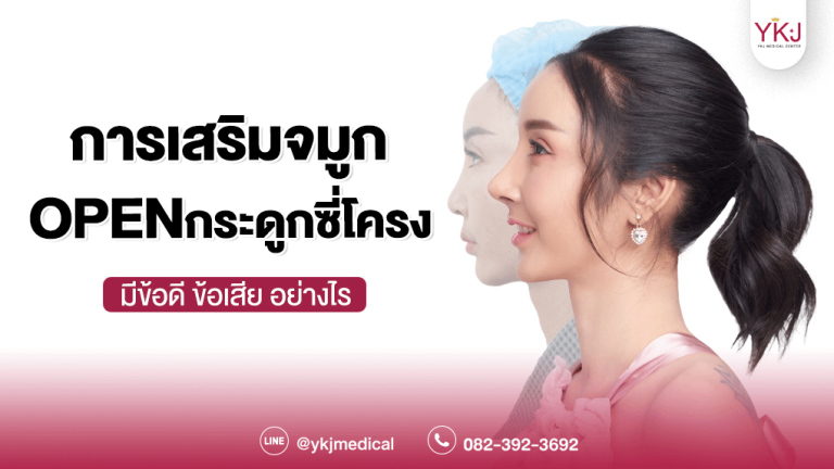 Openกระดูกซี่โครง-Open-ribcartilage