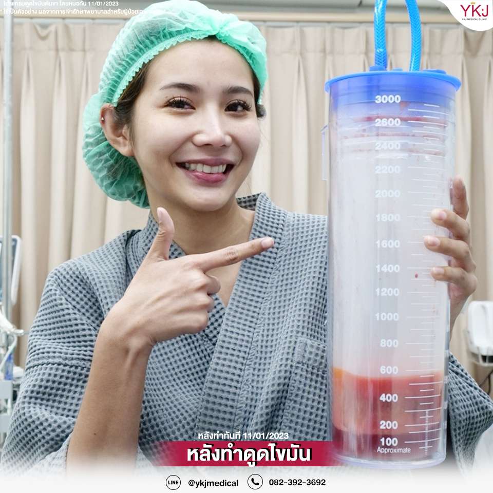 ดูดไขมัน-Liposuction