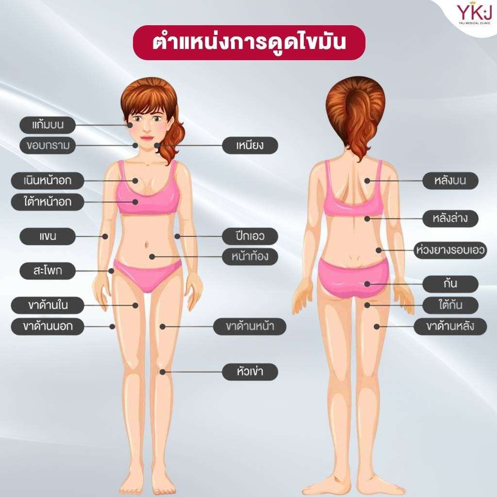 ดูดไขมัน-Liposuction
