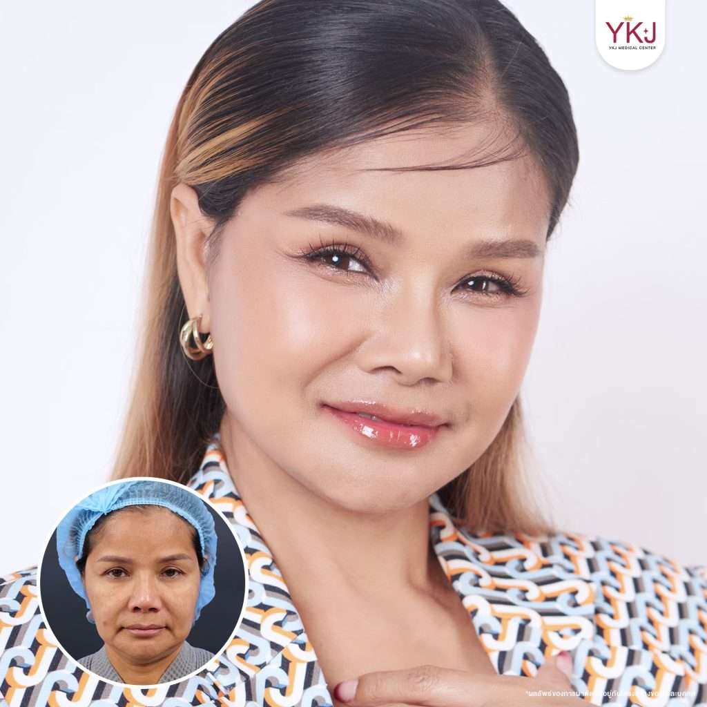 ดึงหน้า-facelift