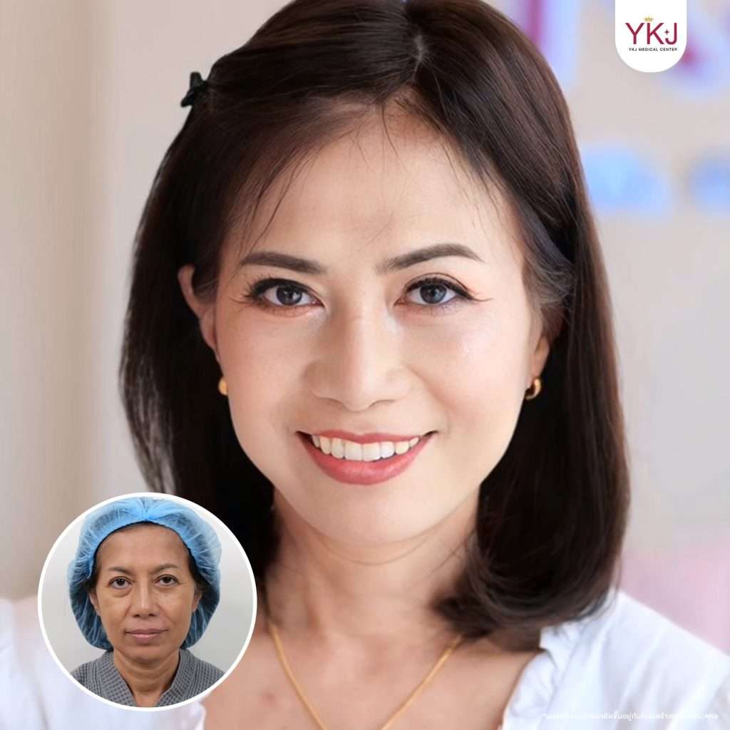 ดึงหน้า-facelift