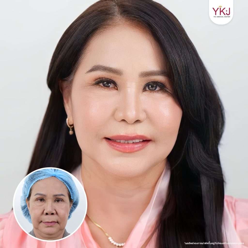 ดึงหน้า-facelift