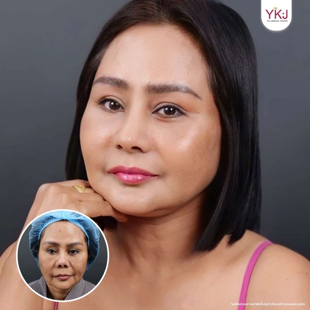 ดึงหน้า-facelift