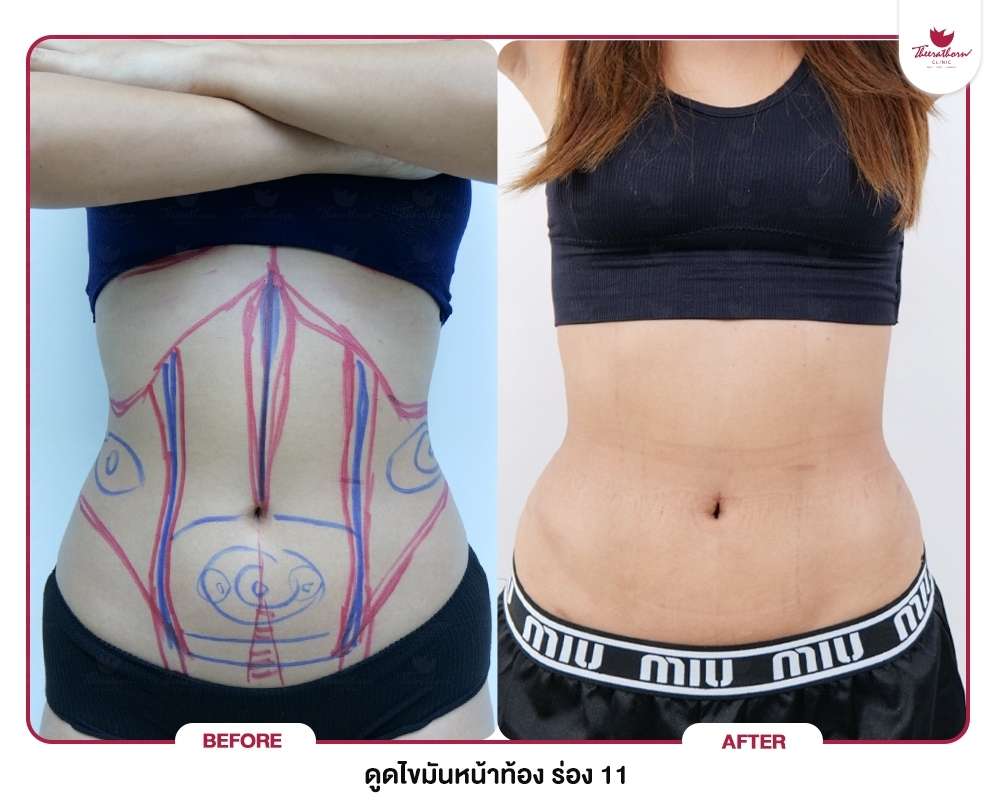 ดูดไขมัน-Liposuction