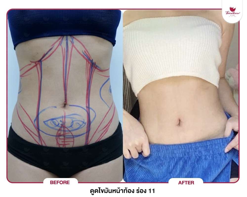ดูดไขมัน-Liposuction