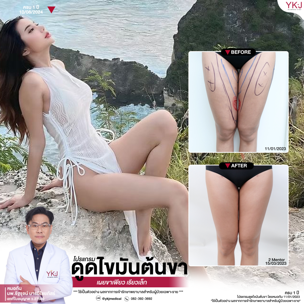 ดูดไขมัน-Liposuction