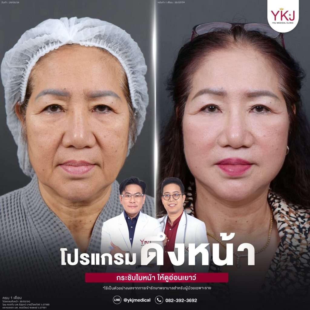 ฉีดสารเหลว-liquid silicone