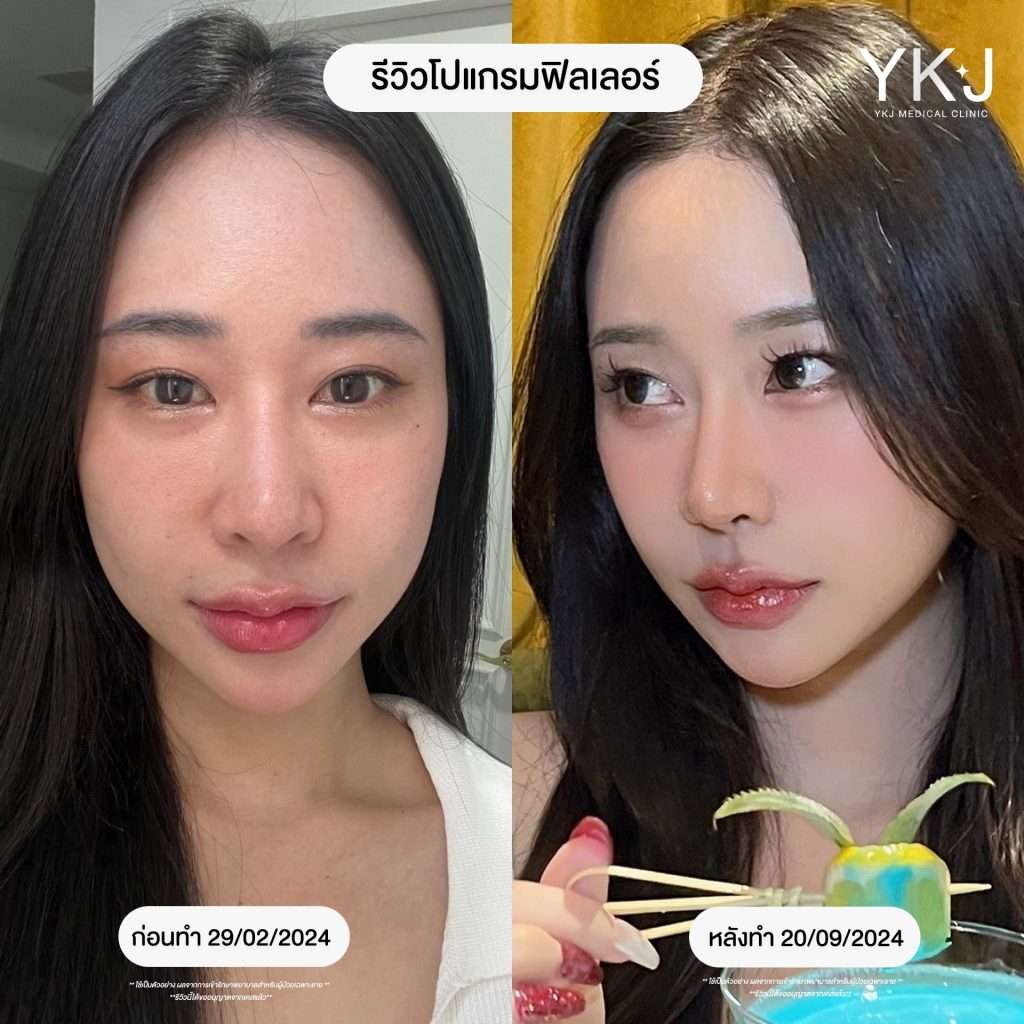 ฟิลเลอร์-filler