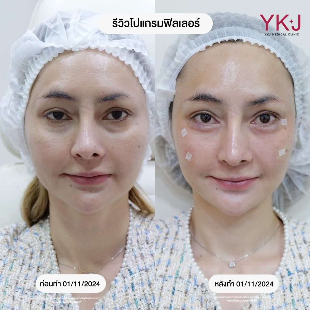 ฟิลเลอร์-filler