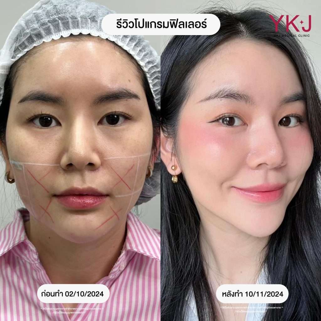ฟิลเลอร์-filler