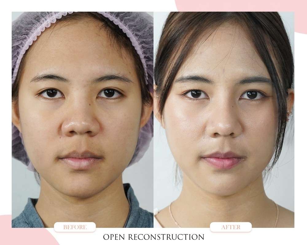 ปีกจมูกบาน-flaring nostrils