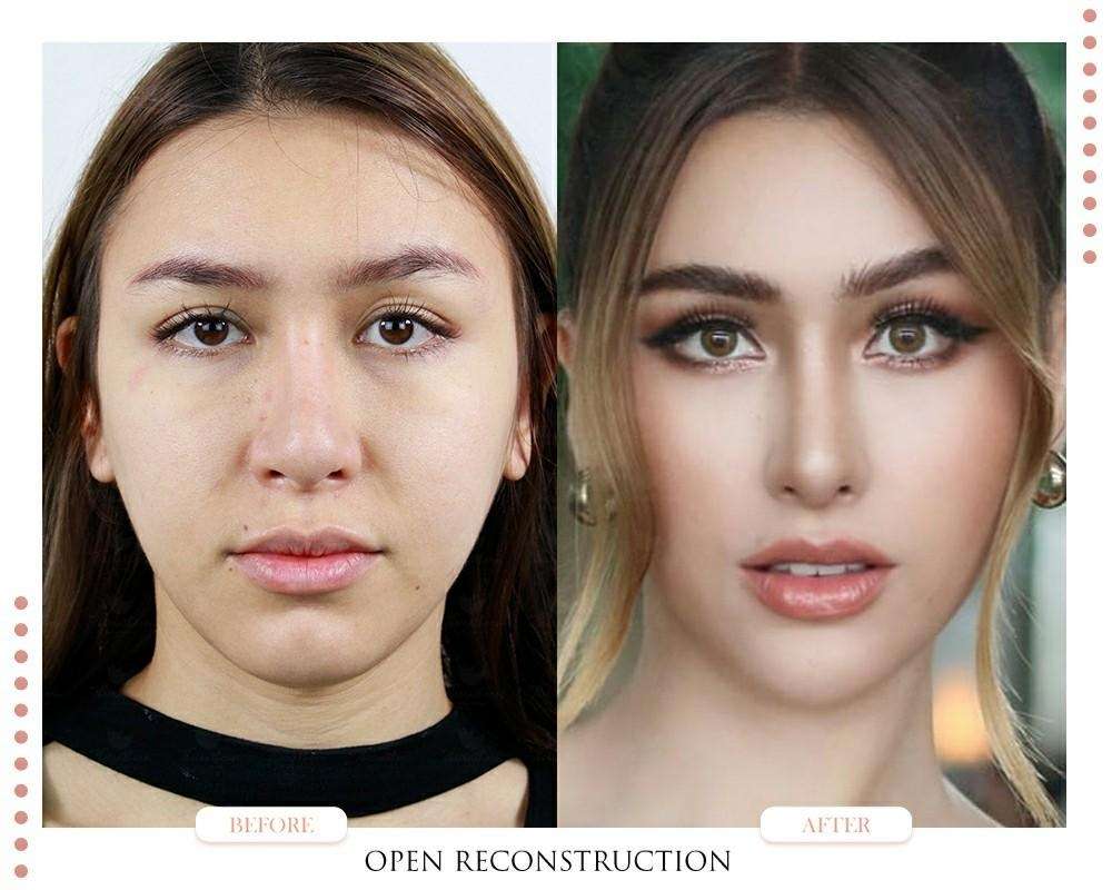 ปีกจมูกบาน-flaring nostrils
