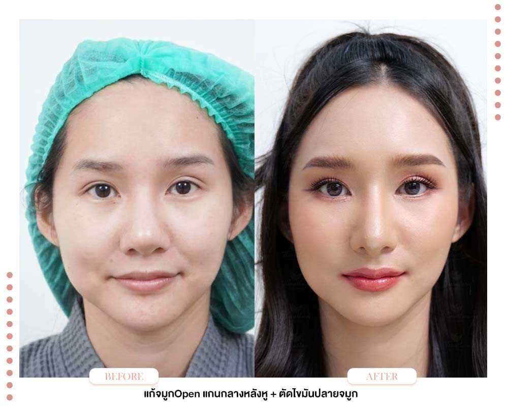 ปีกจมูกบาน-flaring nostrils