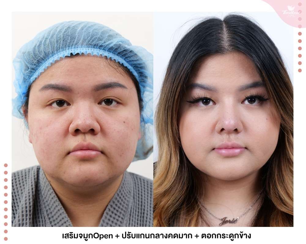 ปีกจมูกบาน-flaring nostrils